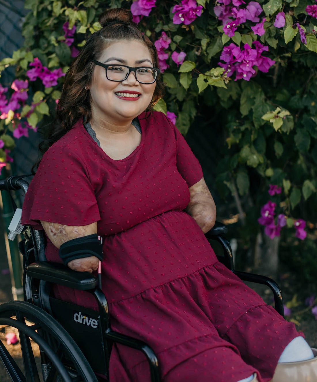 A Disabled Woman With A Prosthetic Leg Laughs In A Beautiful